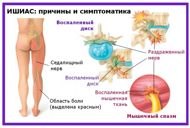Защемления седалищного нерва, медикаментозное лечение - Доктор Позвонков