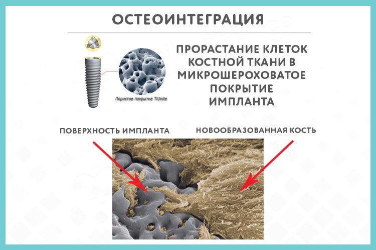 определение понятий имплантация. этапы имплантации. одномоментная имплантация. двухэтапная имплантация зубов этапы. импланты дентиум 3412.