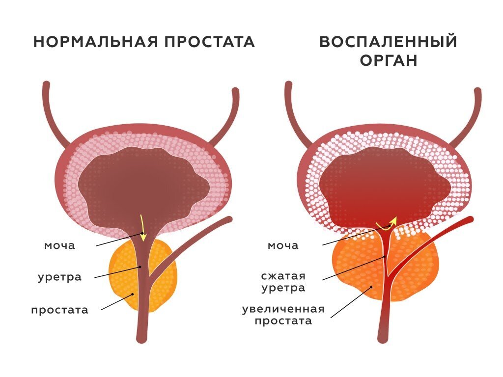 Пример лечения хронического простатита. Простатиты у мужчин симп. Схема лечения острого простатита антибиотиками. Простатит схема. Самодиагностика простаты.