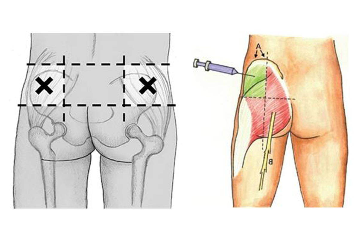 Как ставить укол в ягодицу