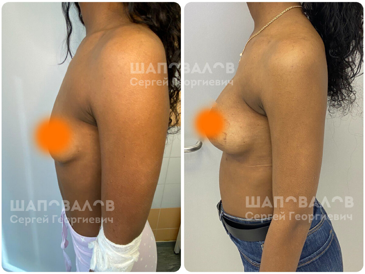 фото «ДО» и фото «ПОСЛЕ» пластики