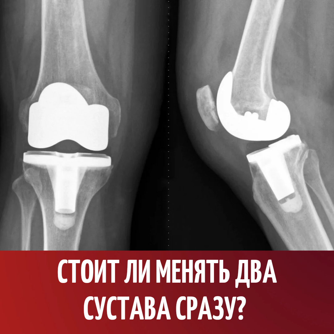 Knee arthroplasty. Омартроз артроз плечевого сустава. Эндопротезирование коленного сустава. Артроз плечевого сустава рентген.