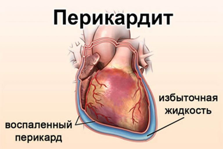 Перикард что это простыми словами. Экссудативный перикардит животных. Заболевание сердца перикардит. Симптомы поражения перикарда. Воспаление околосердечной сумки.