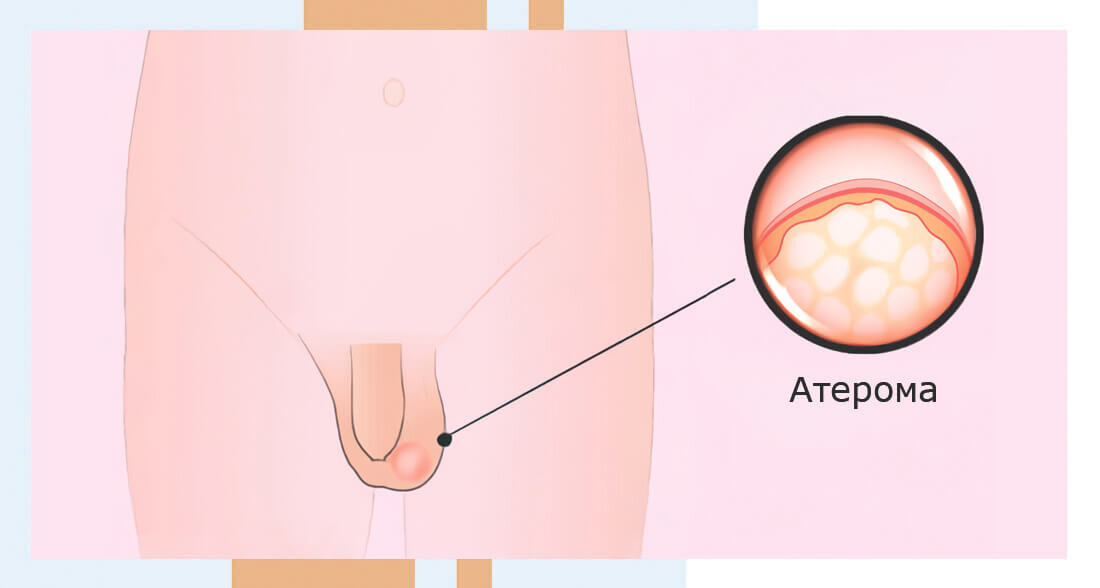 Образования мужских половых органов на примере атеромы