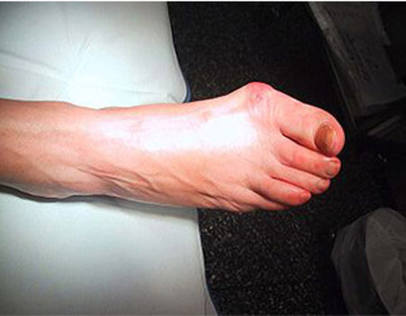 В свои 54 года у меня валгусная деформация стоп, которая раньше устранялась только операцией. 