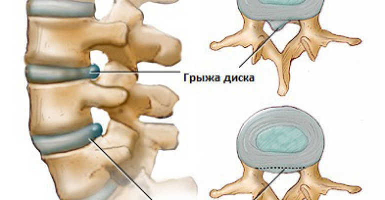 Протрузии межпозвонковых дисков фото