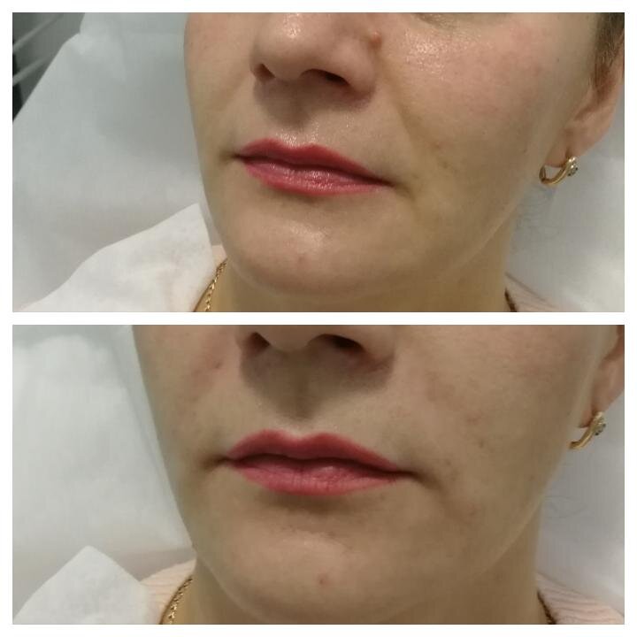 Контурная пластика носогубных складок 