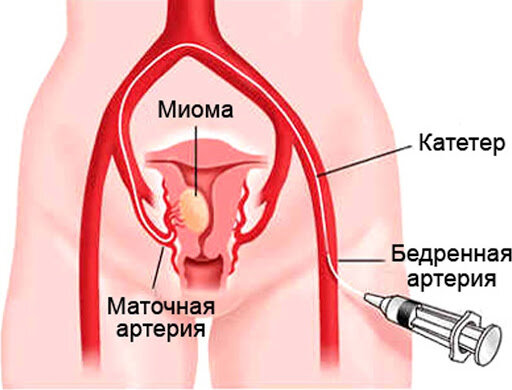 Хирургическая менопауза