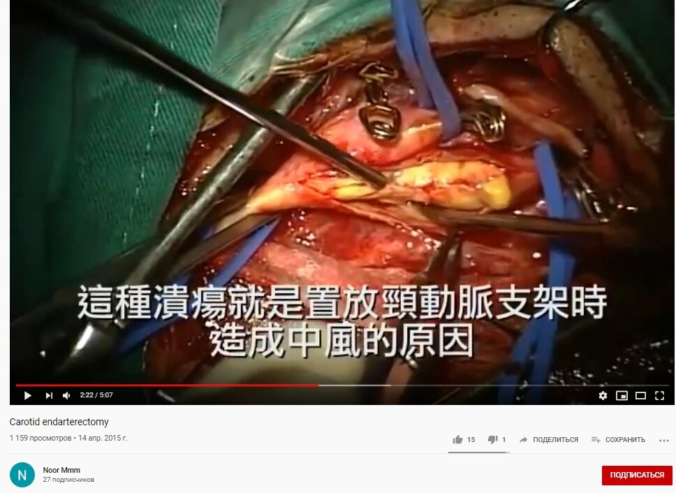 Это секретная бляшка внутри сосуда - она мягкая, эластичная, БЕЗ СКЛЕРОЗА и БЕЗ ПОВРЕЖДЕНИЯ СТЕНКИ СОСУДА.