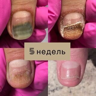 Лечение грибка ногтей (онихомикоз) - блог Виртус