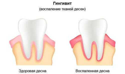 Почему может появиться кислый привкус во рту