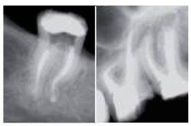 Такую извитую форму могут иметь корневые каналы зуба