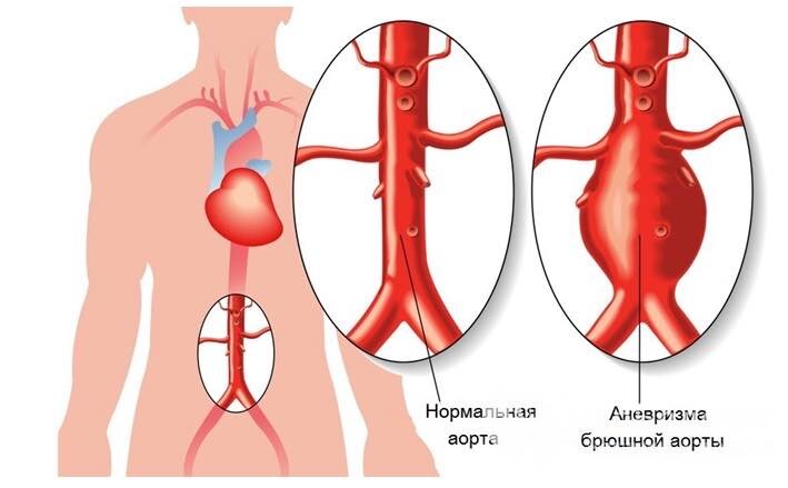 Как выглядит аорта и аневризма аорты.
