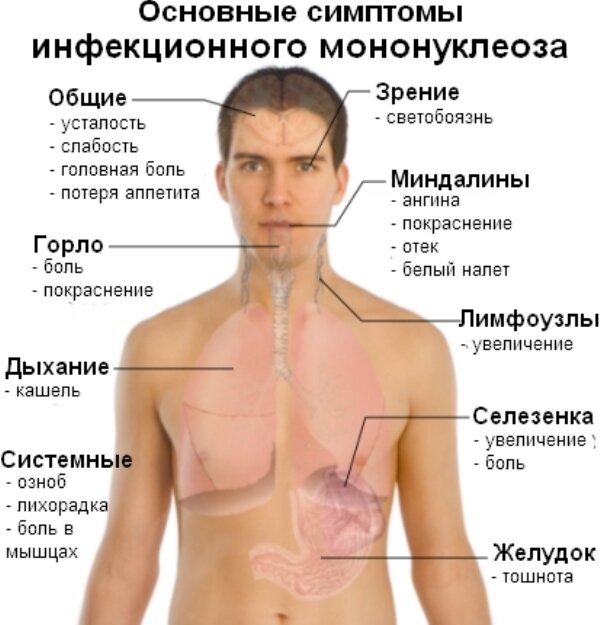 Инфекционный мононуклеоз - Инфекционные болезни - Справочник MSD Профессиональная версия