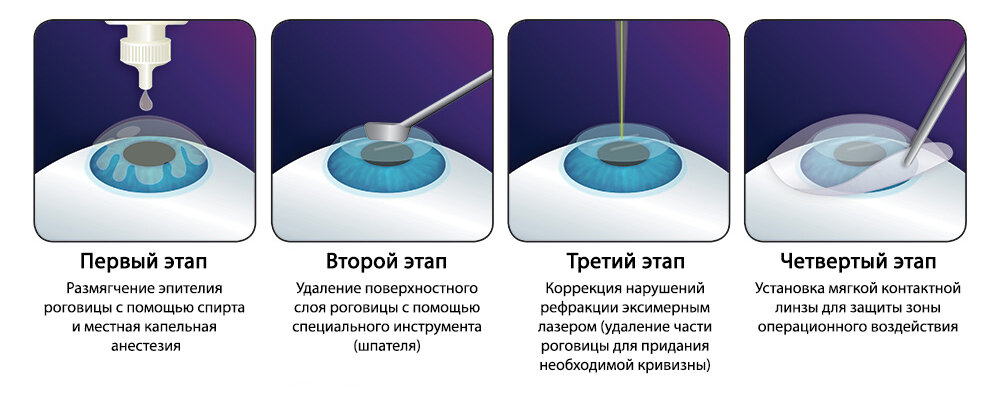 Лазерная коррекция зрения методом ФРК