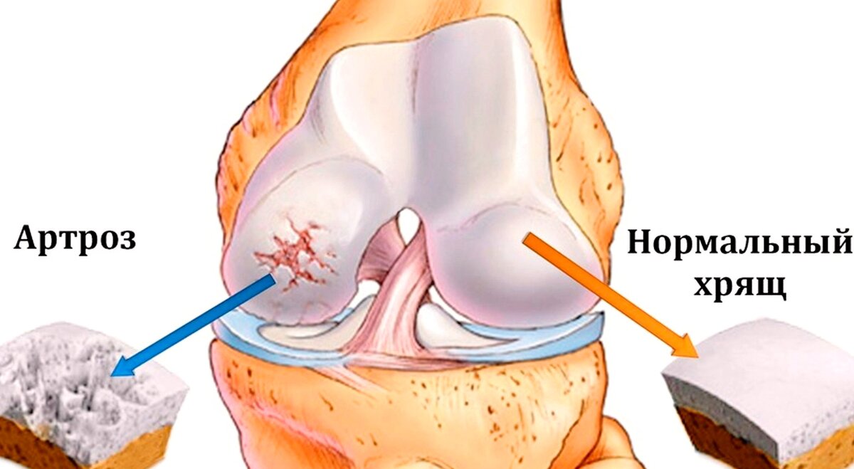 укрепить хрящи