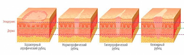 Виды рубцов на коже
