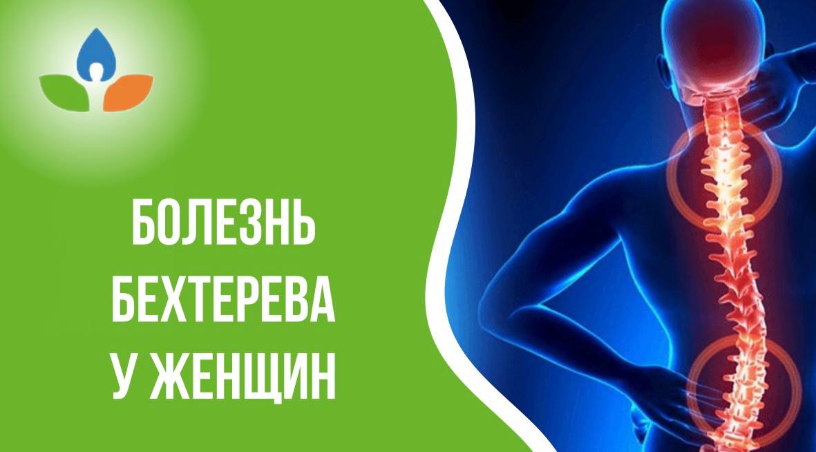 Болезнь бехтерева шейного отдела позвоночника. Болезнь позвоночника болезнь бехтерева. Признаки бехтерева у женщин. Признаки бехтерева у женщин. Признаки бехтерева у женщин.