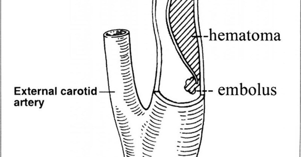 Диссекция церебральной артерии, иллюстрация из открытых источников