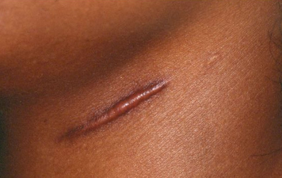 Сделать шрам менее заметным можно с помощью домашних средств