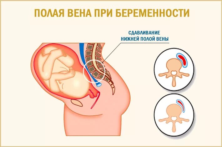 Про синдром сдавливания полой вены., где у беременных находиться полая вена