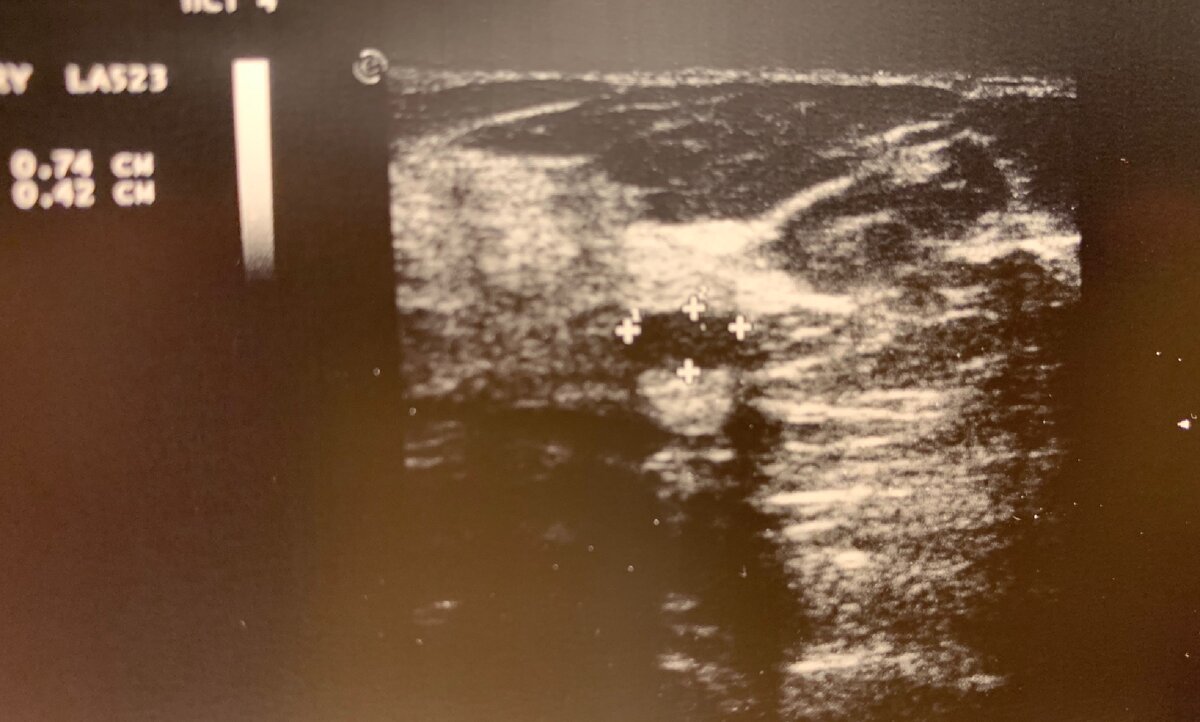 УЗИ молочных желез- гипоэхогенное образование размером 7*4мм, фиброаденома?