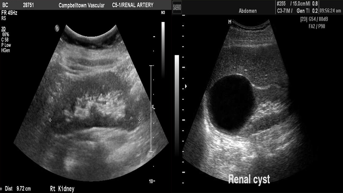 Почка при УЗ-исследовании, слева вариант нормы, справа - большая киста почки