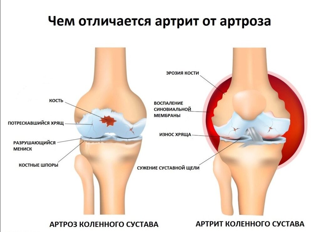 Артроз и артрит коленного сустава