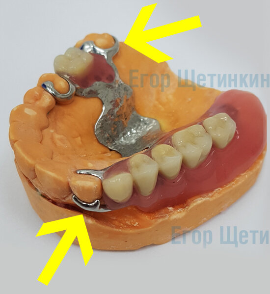 Цельнолитой кламмер на бюгельном зубном протезе.