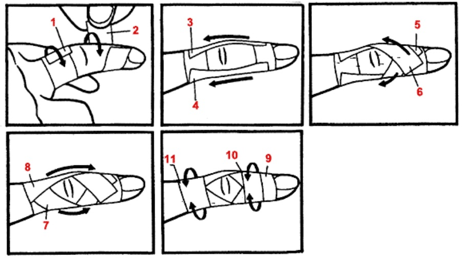 Тейпировать пальцы. Схема тейпирования среднего пальца руки. Схема тейпирования большого пальца на руке. Тейпирование запястья схема. Как правильно тейпировать пальцы в волейболе пластырем.