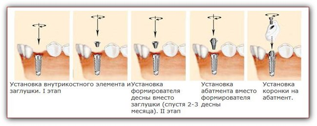 Замена коронок