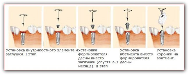 После чего устанавливают