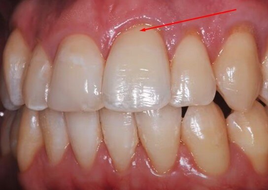 Восстановление зуба коронкой (искусственная десна для металлокерамической коронки)