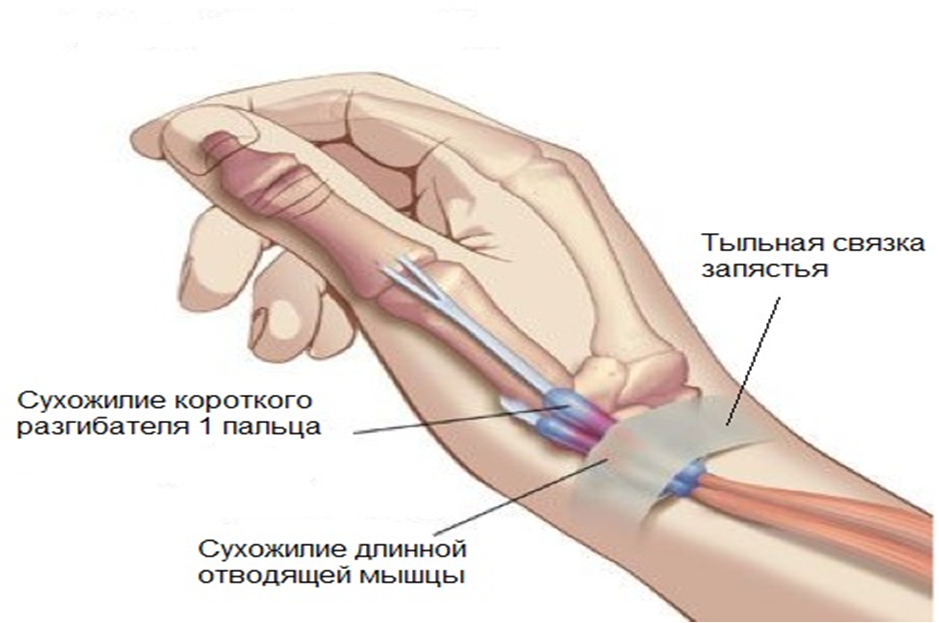 Tendinitis antebrazo tratamiento