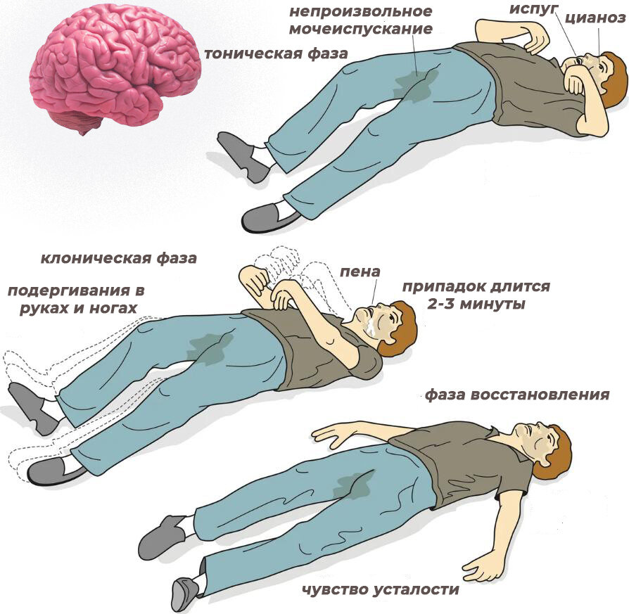 Неотложная помощь при эпилептическом припадке