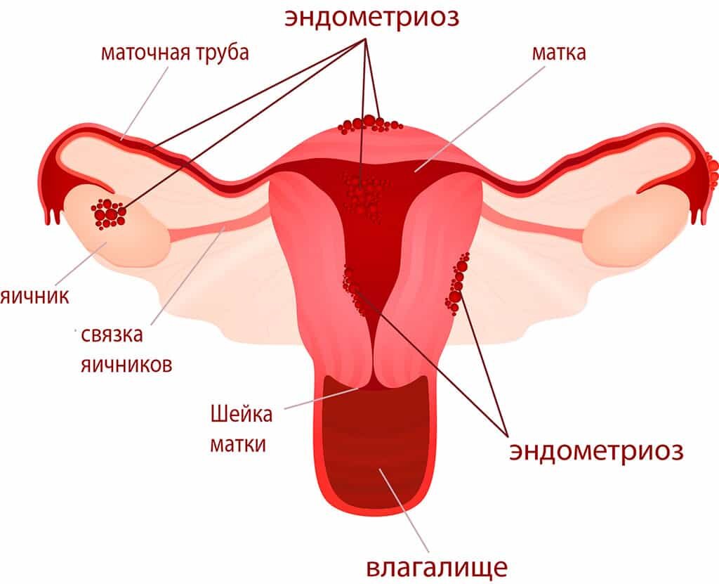 Теперь эндометриоз будет проще вылечить — Японские ученые сделали важное  открытие | Рея: медиа о женщинах и женском здоровье | Дзен