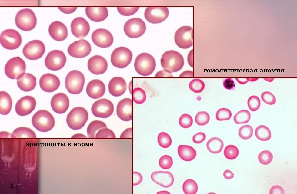 Окрашенные препараты крови собаки в норме и при гемолитической анемии