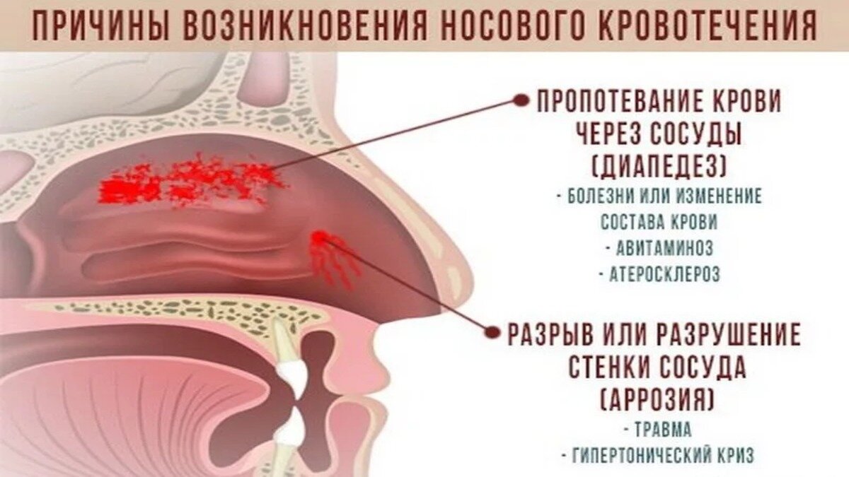 Причины неожиданного кровотечения из носа: что сказывается на вашем здоровье