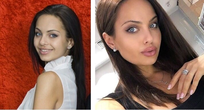 Ассоль фото до и после пластики