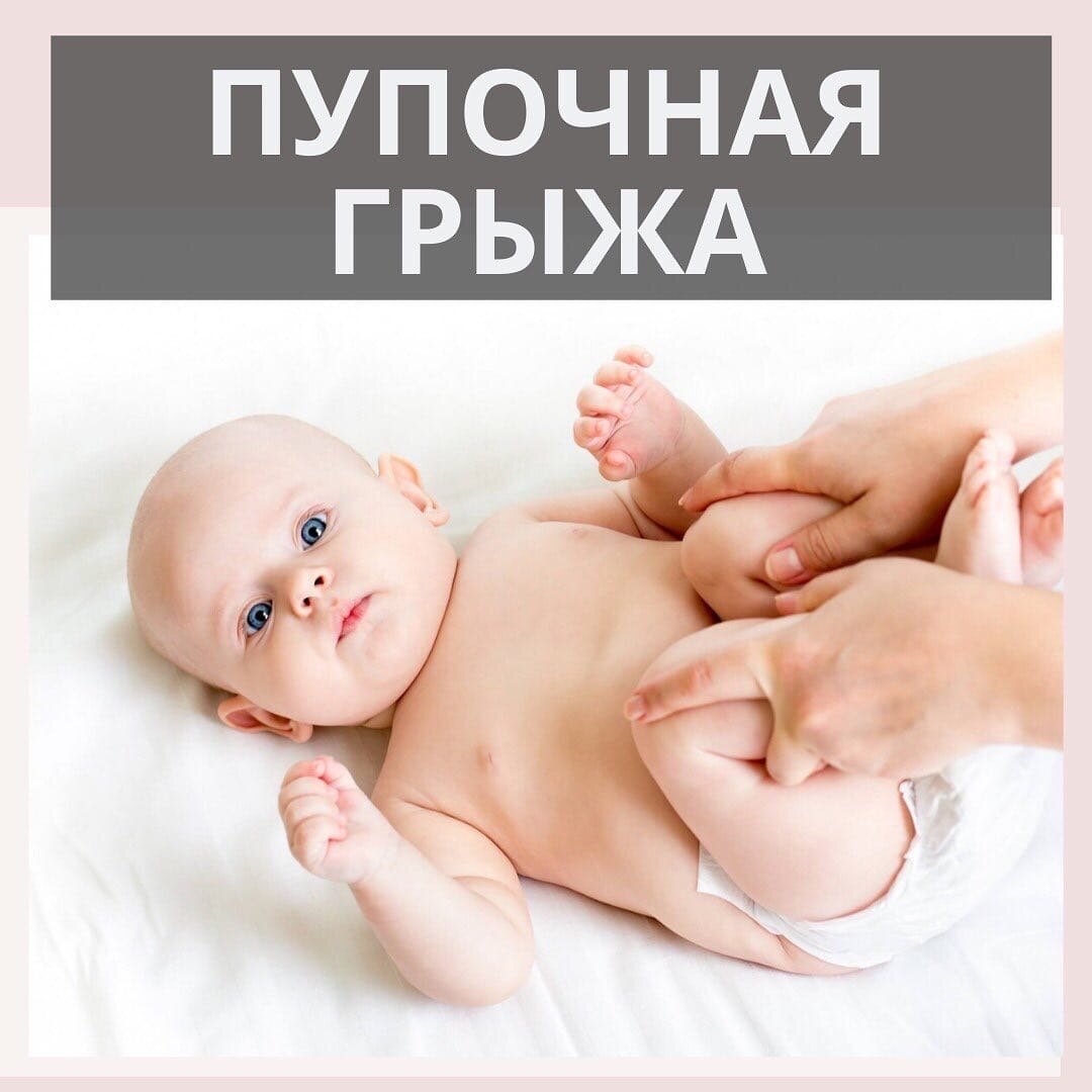 ПУПОЧНАЯ ГРЫЖА ⠀
▪ это расширение пупочного кольца, через которое выпячивается содержимое брюшной полости (петли кишечника).
⠀
Звучит не очень, да?
Но на самом деле все не так страшно!
⠀
Ставим ❤ и продолжаем читать!
⠀
❓КАК ОБНАРУЖИТЬ
⠀
Понять, что у малыша есть пупочная грыжа не сложно. Вы увидите бугорок в области пупка, который можно вправить обратно.
⠀
Возникает она из-за слабости или отсутствия мышц, клетчатки в зоне пупка (пупочное кольцо).
⠀
Когда малыш сильно плачет, кашляет, у него вздутие живота или запор, то повышается внутрибрюшное давление, пупок выпирает еще больше, и грыжа, которая была незаметной становится видимой. И это норма!
⠀
Бывает, что видимого выпячивание нет, но при осмотре врач может обнаружить расширенной пупочное кольцо и поставить диагноз.
⠀
❓ЛЕЧЕНИЕ ПУПОЧНОЙ ГРЫЖИ
⠀
Если нет болезненности, отеков или изменения цвета в области выпячивая, достаточно наблюдения у хирурга.
⠀
НО отлично помогают:
⠀
✅массаж и специальный упражнения при пупочной грыже
✅хороший эффект даёт тейпирование (делает только специалист ❗)
⠀
Если ребенок с грыжей бодр, весел, у него отличный аппетит - все хорошо. По мере взросления грыжа пройдет. Чаще всего к 3-5 годам закрывается сама.
⠀
‼Существует миф: пупочную грыжу можно «накричать».
⠀
Пупочная грыжа врожденное состоянии, и крик здесь ни при чём!
⠀
⬆Уже писала выше про повышение давления, из-за которого грыжа просто становится видимой.
⠀
⁉Была у вашего ребёнка грыжа?
Пишите в комментариях, как боролись.