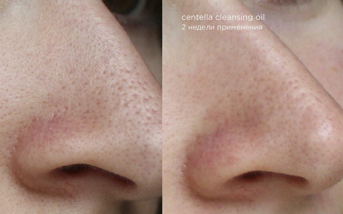 Фото До/После. Комбинированная кожа. Срок применения масла - 2 недели. 