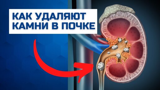 Удаление камней из почек. Методы лечения мочекаменной болезни