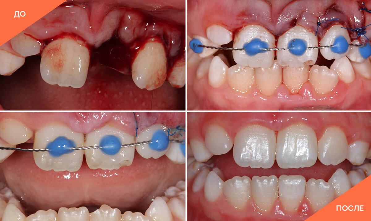 Реплантация зуба: основные показания и противопоказания | Стоматология ...