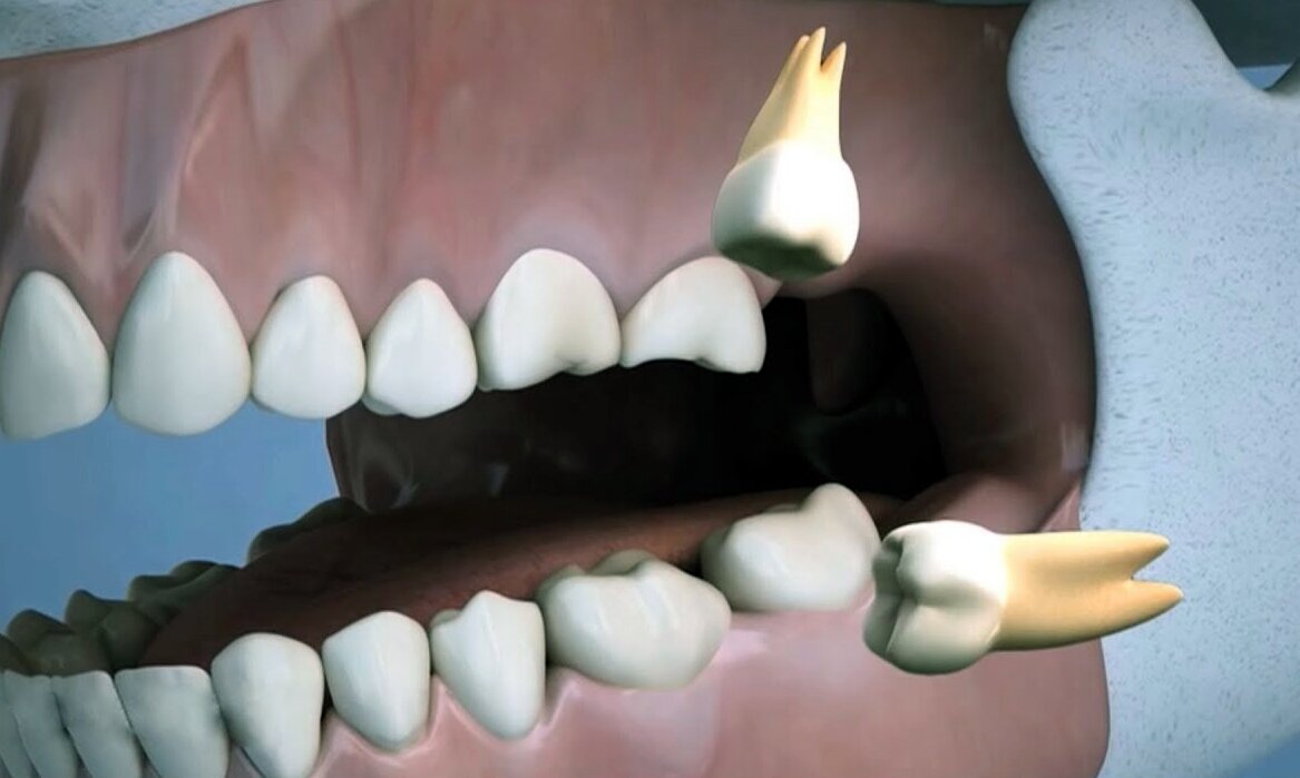 Третьи моляры, зубы мудрости, восьмёрки - удалять или не удалять?