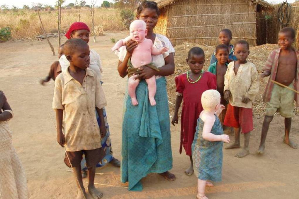 Племя куна Панама альбиносы. Альбиносы африканцы Танзания.