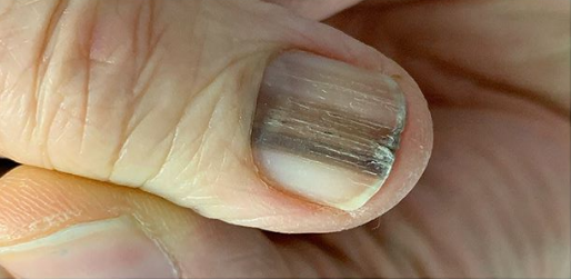 Темные полоски на ногтях оказались признаком болезней сердца: Из жизни: жк-вершина-сайт.рф