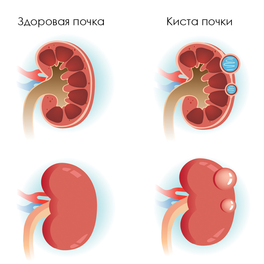 Кисты в почке – почему появляются и что делать? | Evolutis Clinic | Дзен