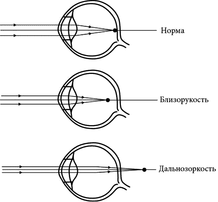 Схематическое изображение аномалий рефракции глаза.