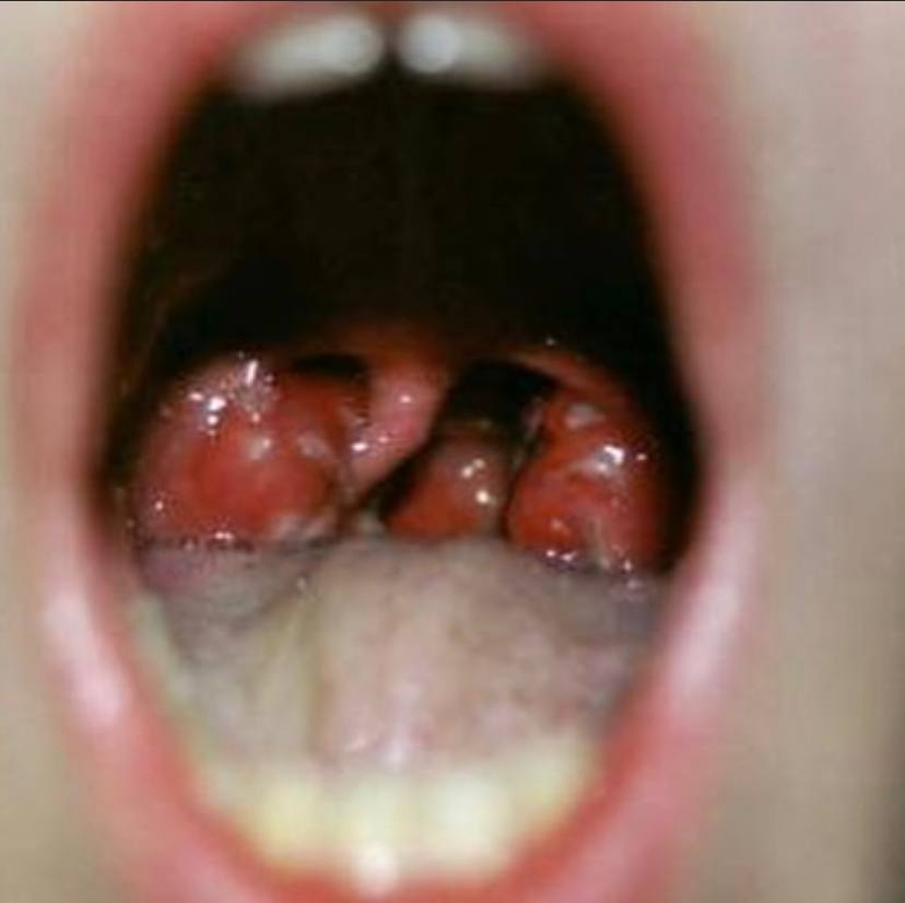 Так может выглядеть горло при скарлатине. Картинка с сайта medscape.com