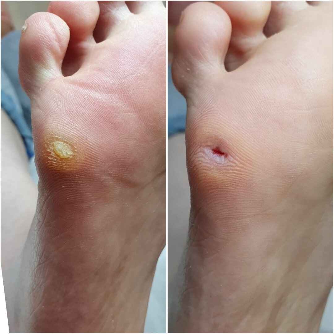 Стержневая мозоль на стопе